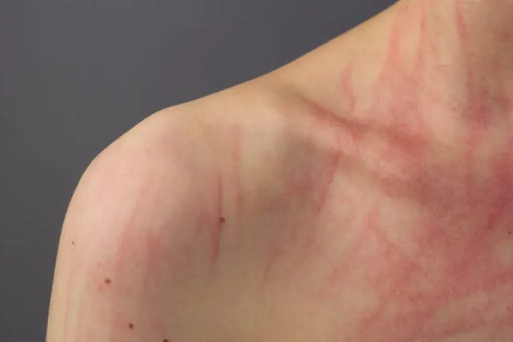 Zdjęcie Alergia na tle nerwowym: objawy, jak rozpoznać i leczyć