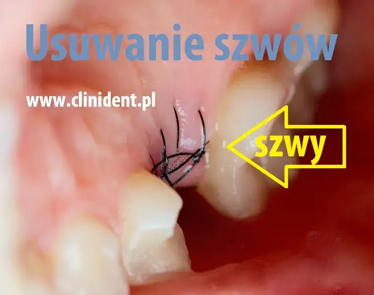 Zdjęcie Ile kosztuje zdjęcie szwów z dziąsła? Cena, NFZ i przebieg zabiegu