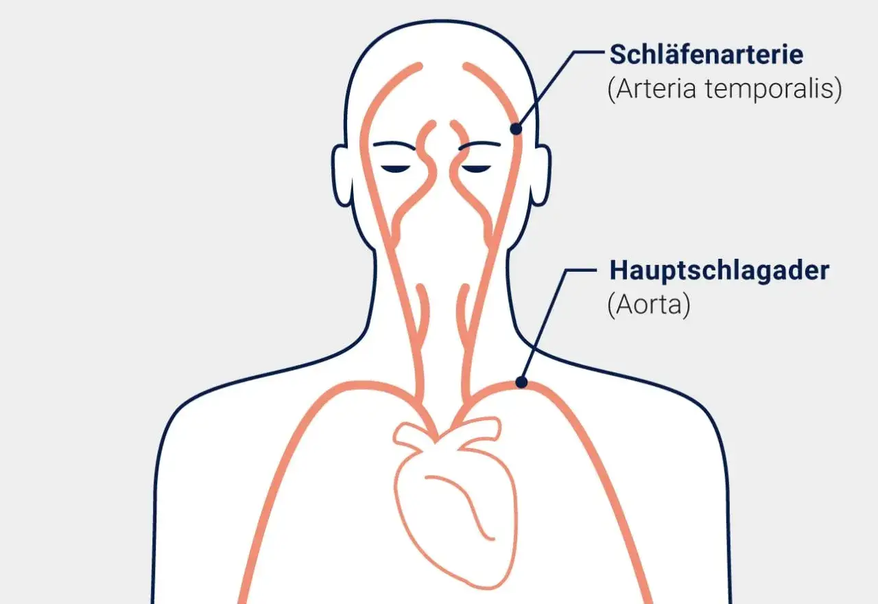 Zdjęcie Morbus Horton Diagnostik: Wichtige Kriterien und Symptome erkennen