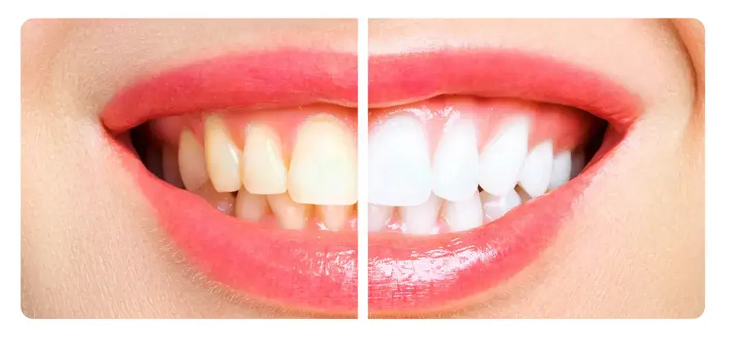 Zdjęcie Hollywood smile co to jest i jak osiągnąć idealny uśmiech