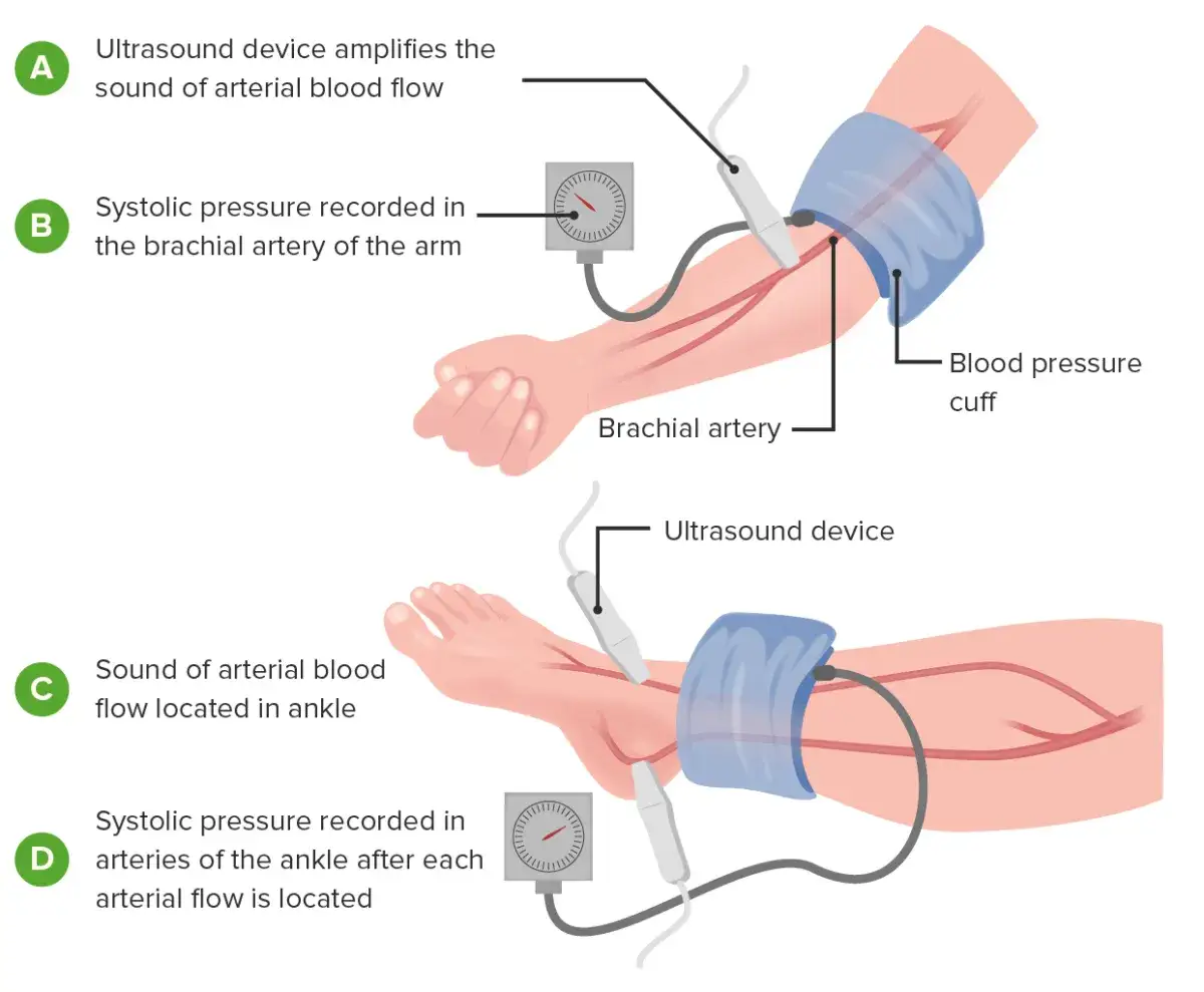 Zdjęcie Wichtige Diagnosetechniken der peripheren arteriellen Verschlusskrankheit
