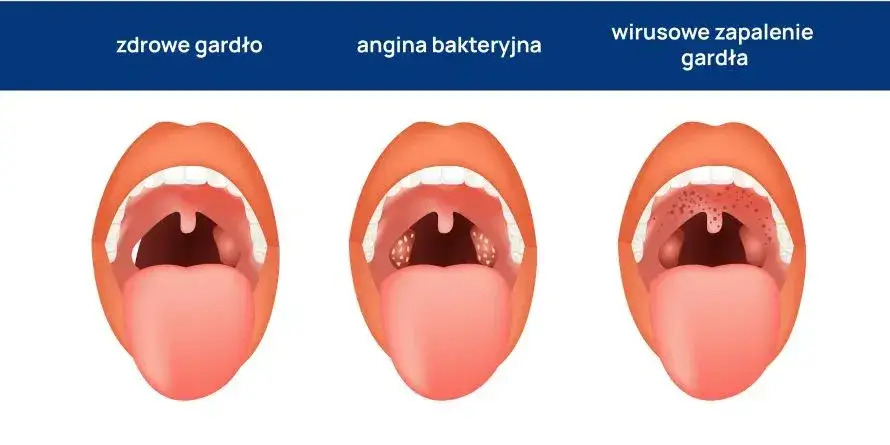 Zdjęcie Ile trwa angina ropna u dziecka? Objawy i skuteczne leczenie