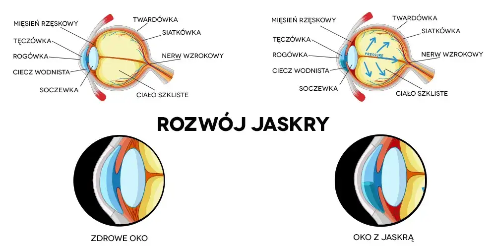 Zdjęcie Od czego jest jaskra? Poznaj przyczyny i ryzyko tej choroby oczu