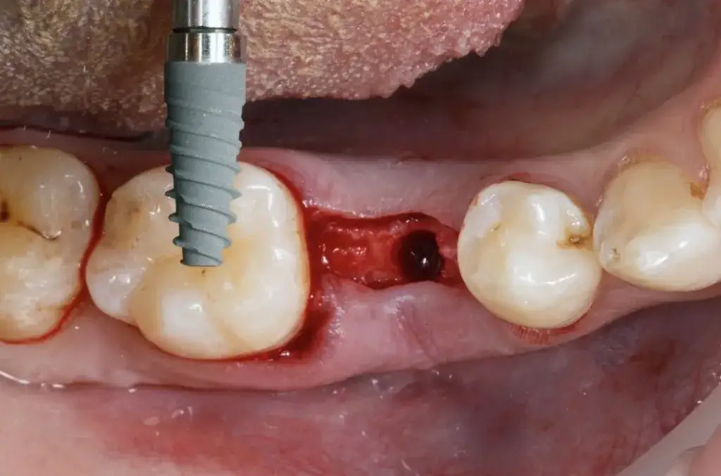 Kiedy implant po wyrwaniu zęba? Poznaj kluczowe terminy i ryzyka