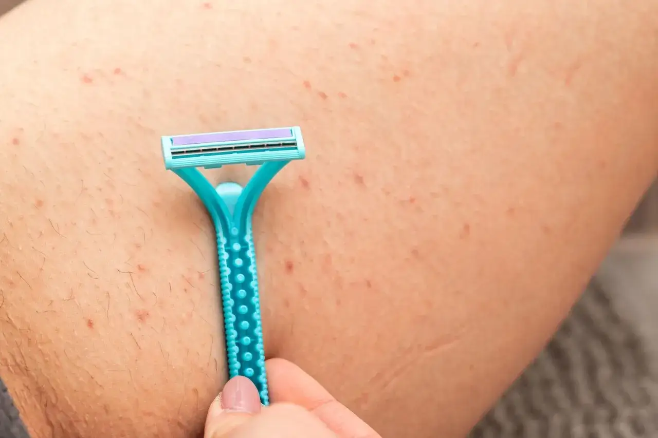 Jak pozbyć się podrażnień po goleniu bikini - skuteczne sposoby na ulgę