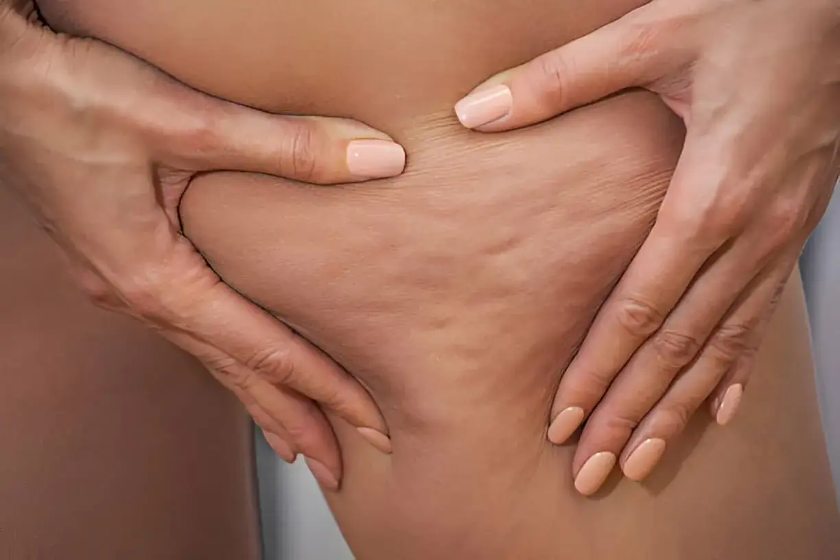 Manos pellizcando piel con celulitis edematosa, mostrando la textura irregular y abultada.