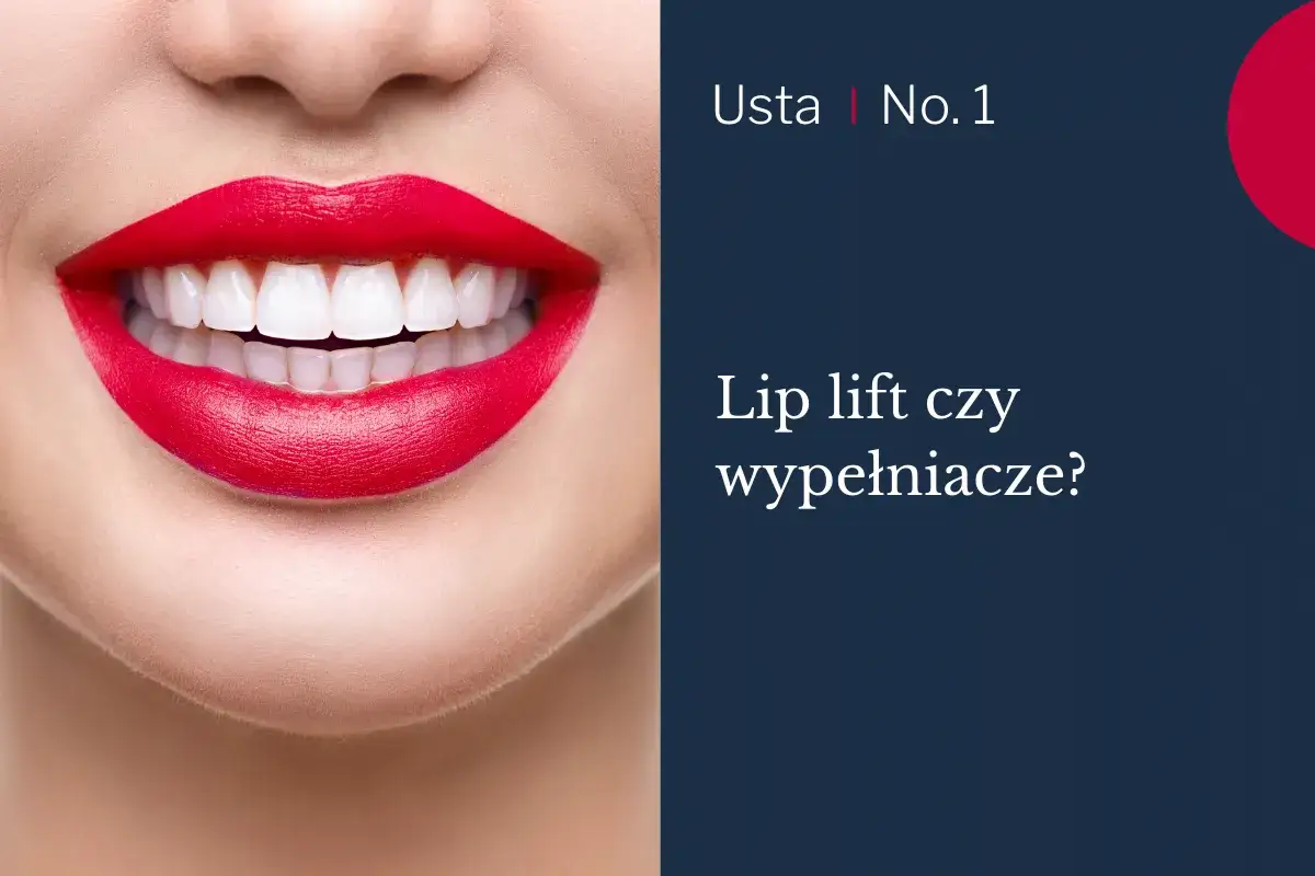Usta po zabiegu lip lift, z idealnie białymi zębami i czerwonymi ustami.