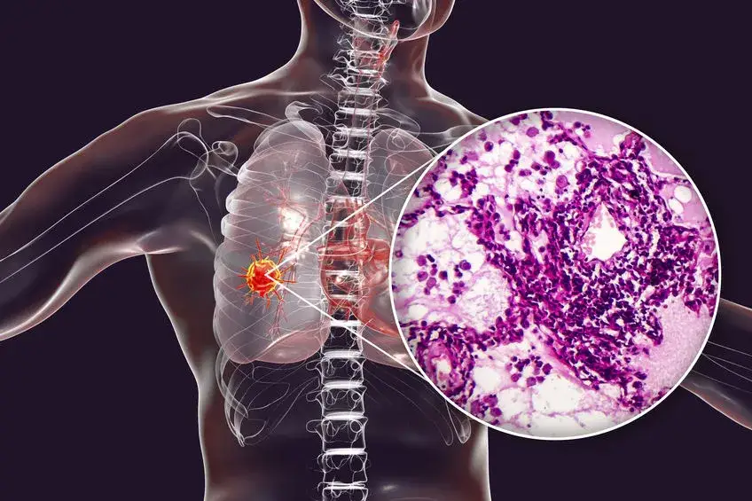 Pakiet badań nowotworowych dla mężczyzny: kompleksowa diagnostyka raka