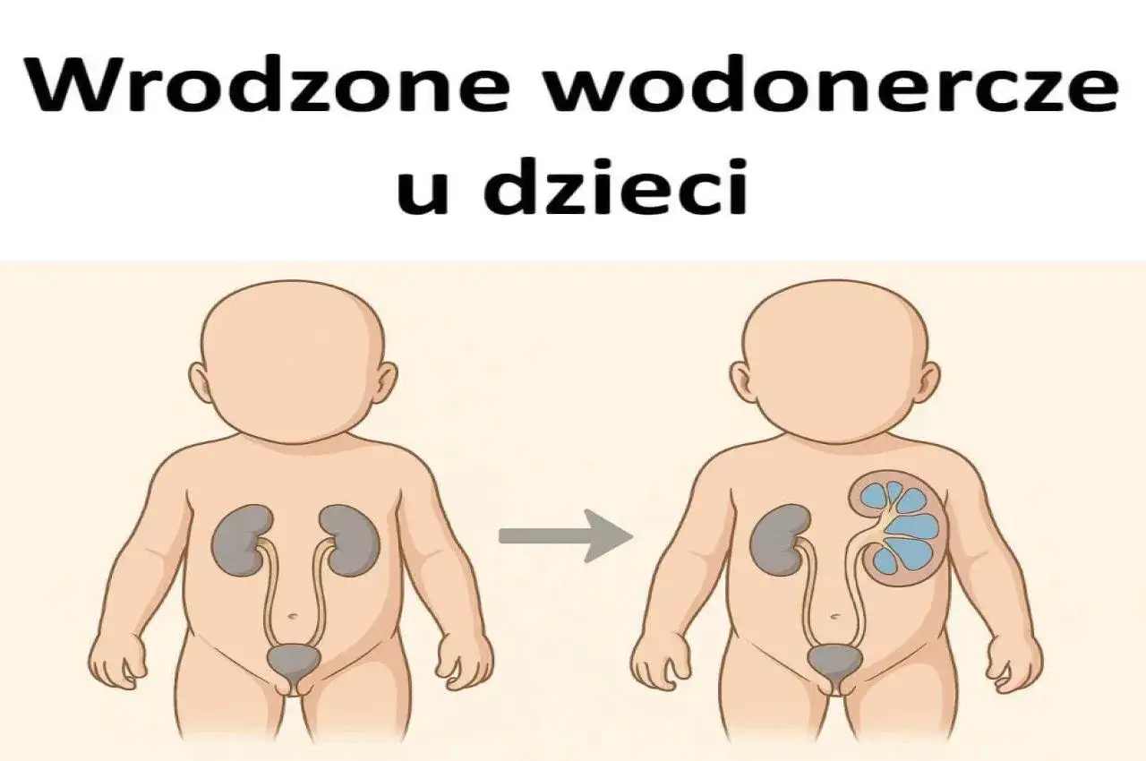 Ilustracja pokazuje rozwój wrodzonego wodonercza u noworodka. Po lewej zdrowa nerka, po prawej powiększona, z widocznymi zbiornikami moczu.