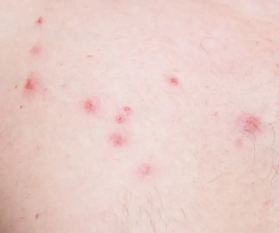 Najskuteczniejsze sposoby na pozbycie się krostek po goleniu: sprawdzone metody