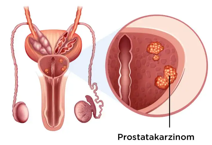 Was wird bei der Prostatakrebs Vorsorge gemacht? Wichtige Schritte erklärt