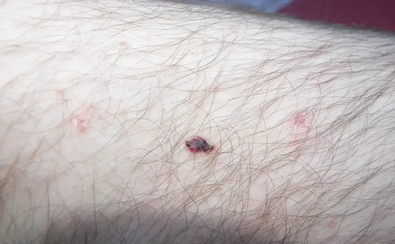 Zbliżenie na skórę z włosami, widoczne są drobne, czerwone pieprzyki na ciele, jeden z nich jest ciemniejszy i lekko krwawi.