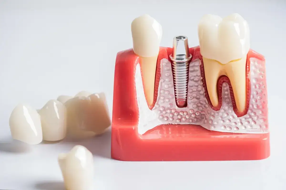 Ból po wyrwaniu ósemki: Ile trwa, co jest normą i kiedy do dentysty?