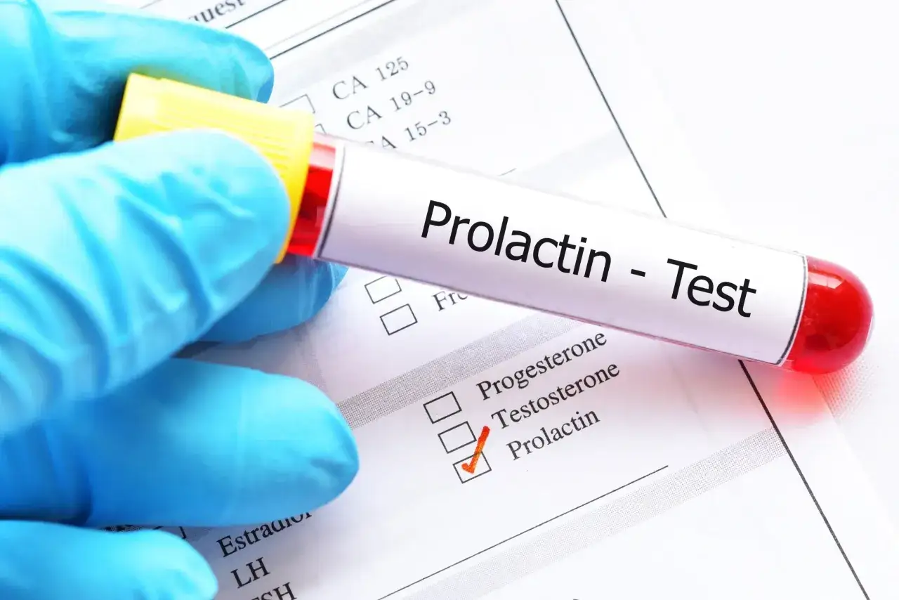 Hiperprolaktynemia: objawy, diagnostyka i jak obniżyć prolaktynę?