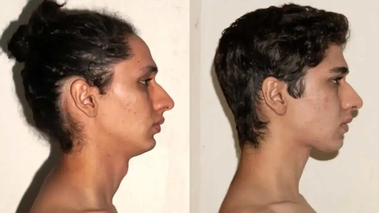 Comparación de perfiles faciales. El lado izquierdo muestra una mandíbula retraída, mientras que el derecho, tras practicar que es mewing, revela un perfil más definido.