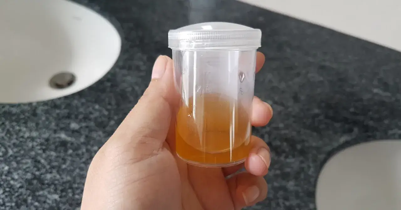 Próbka moczu z widocznymi fosforanami bezpostaciowymi, ważna w diagnostyce ciąży.
