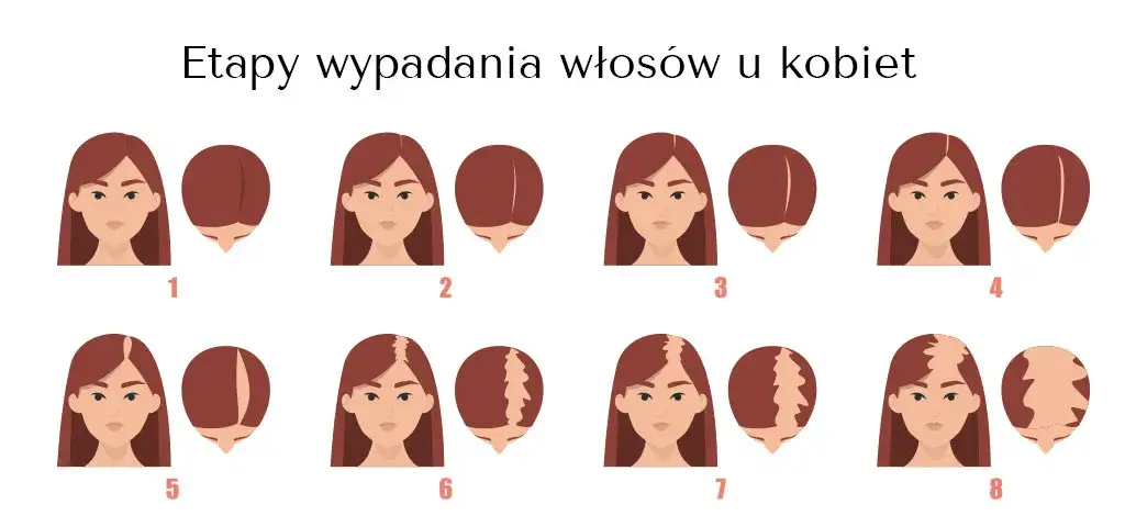 Łysienie androgenowe u kobiet: objawy, przyczyny i wpływ