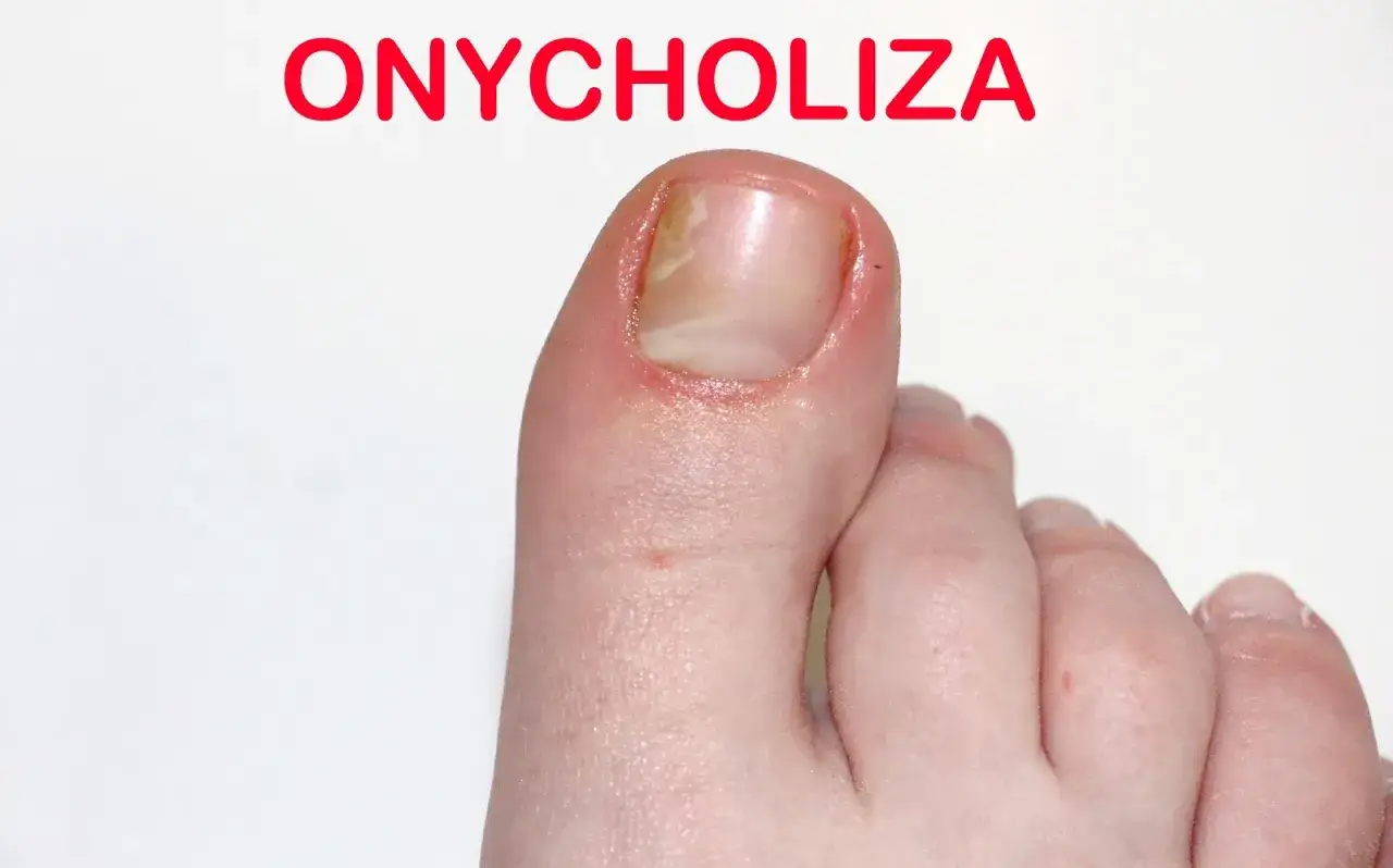 Onycholiza po hybrydzie: skuteczne metody leczenia i zapobiegania