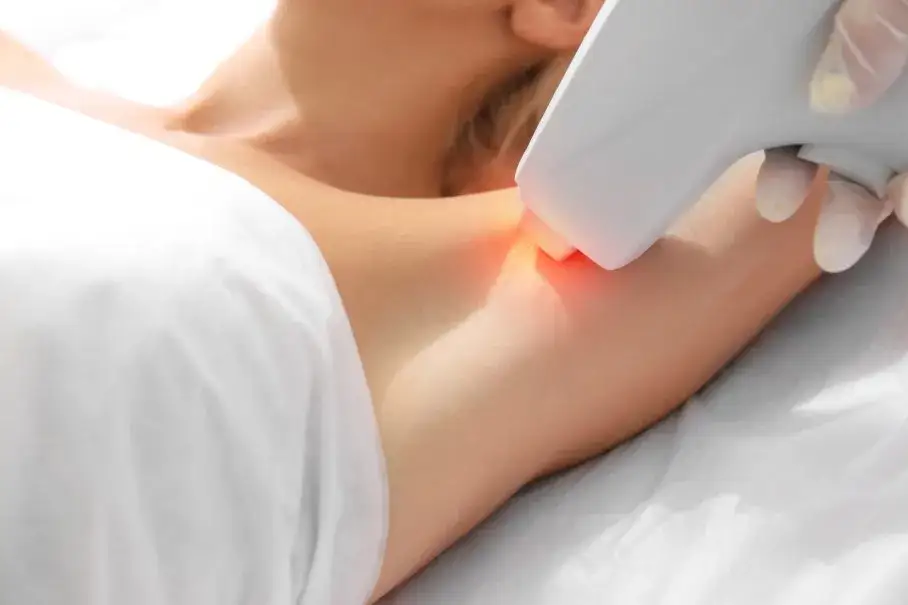 Epilacja laserowa co to – skuteczna metoda trwałego usuwania włosów