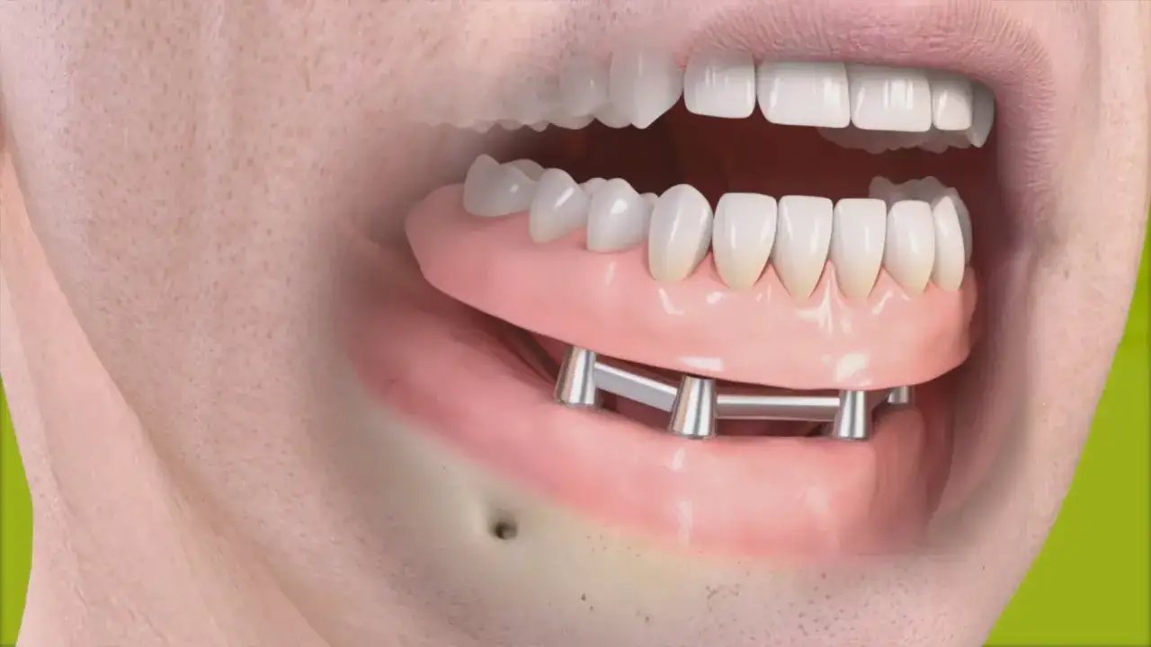 Implant zębowy: Bez bólu i strachu? Poznaj 5 etapów zabiegu