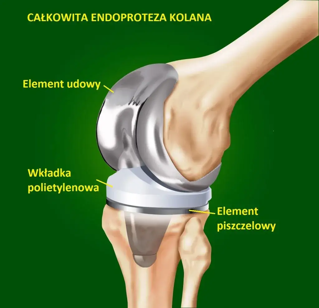 Najszybsze terminy na endoprotezę stawu kolanowego NFZ: lista placówek