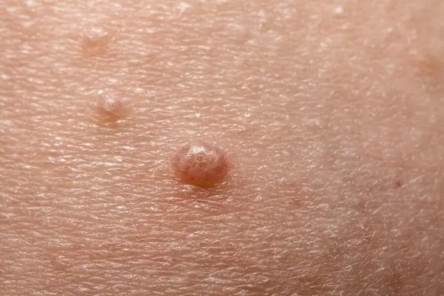 Jakie są objawy mięczaka zakaźnego? Poznaj 7 najczęstszych symptomów