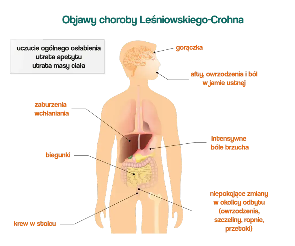 Choroba Leśniowskiego-Crohna: objawy w jamie ustnej, które musisz znać