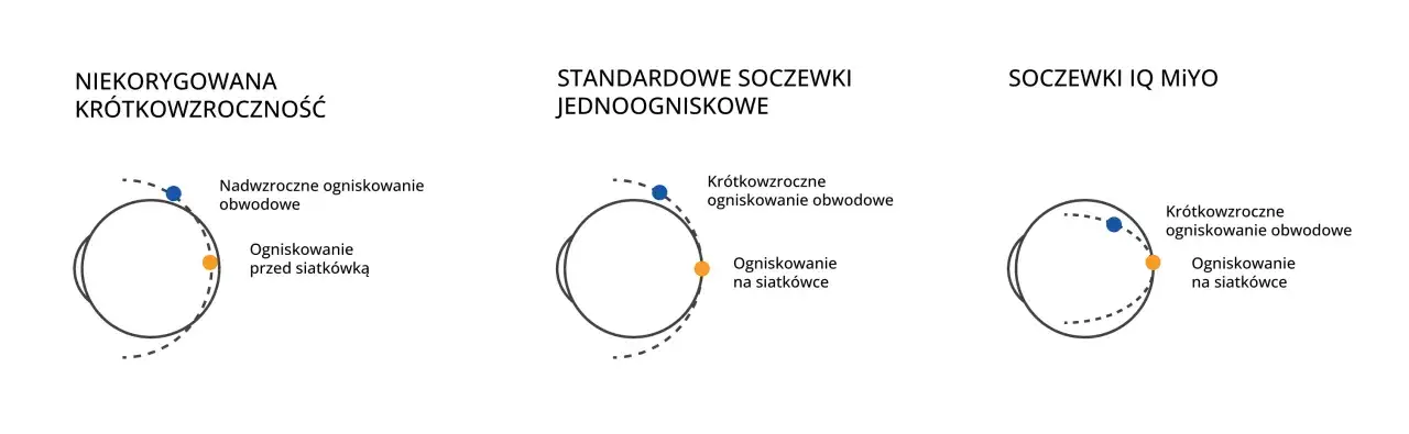 Schemat oka z ogniskowaniem światła przy krótkowzroczności i korekcji soczewkami.