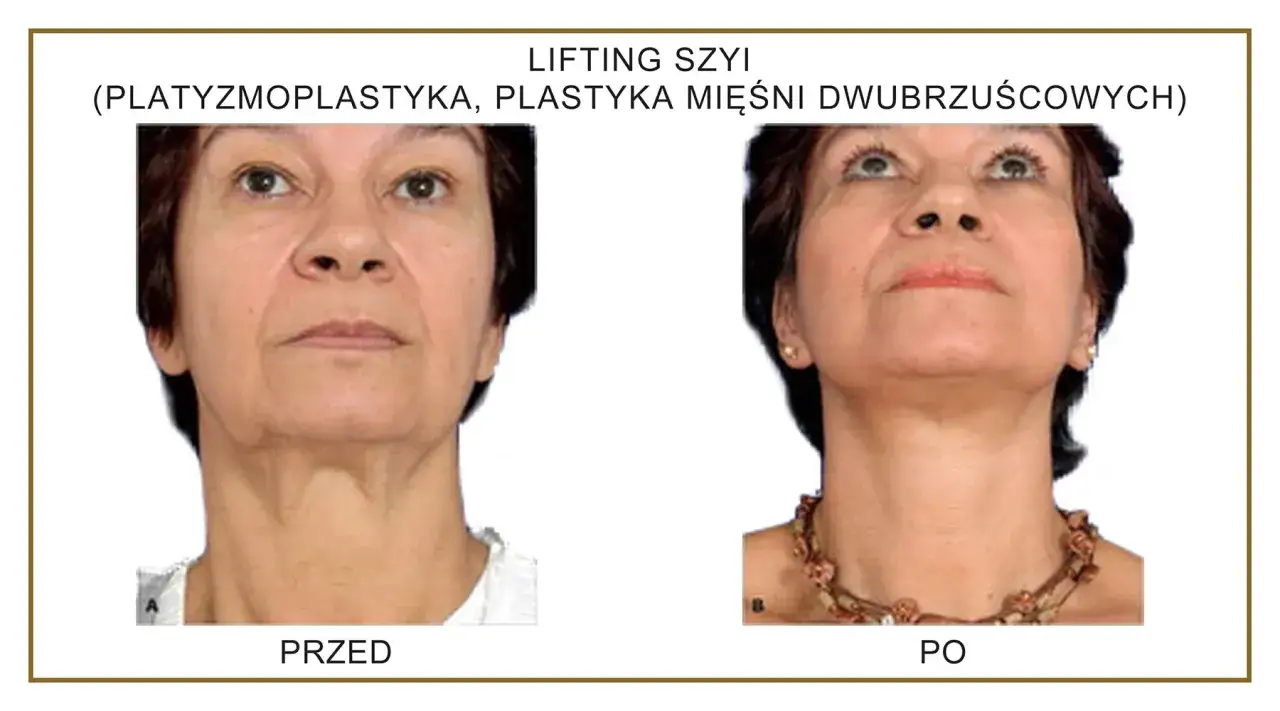 Przed i po zabiegu liftingu szyi. Widoczna poprawa napięcia skóry i konturu.