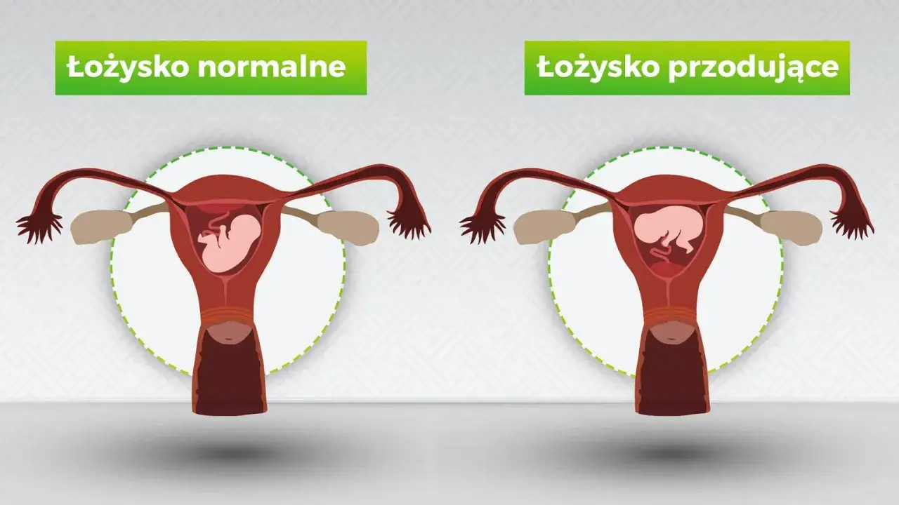 Porównanie: łożysko normalne vs. łożysko przodujące. Ilustracja pokazuje macicę z płodem, gdzie w jednym przypadku łożysko jest prawidłowo umiejscowione, a w drugim przoduje.