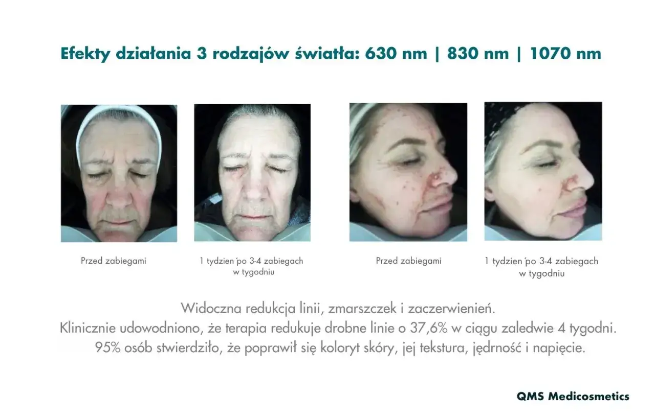 Przed i po terapii światłem LED w domu. Zmniejszenie zmarszczek i zaczerwienień. Poprawa kolorytu, tekstury i jędrności skóry.