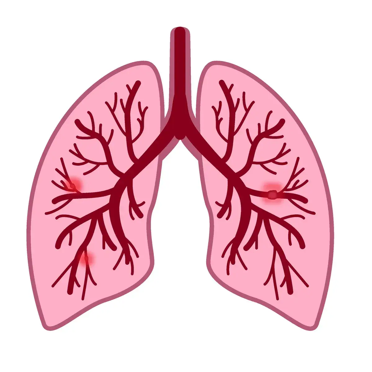 Angio-TK w diagnostyce zatorowości płucnej – skrzeplina w świetle tętnicy płucnej i ocena miąższu płuc
