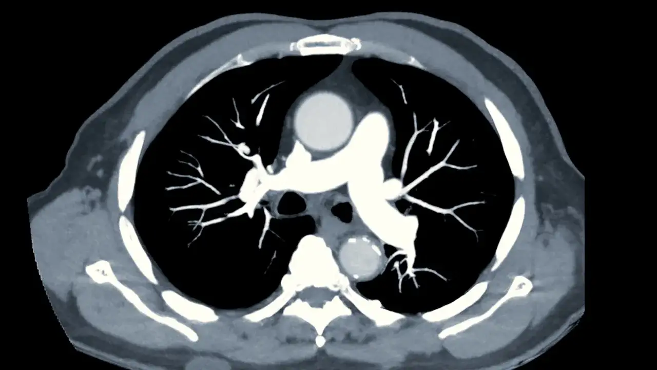 RTG klatki piersiowej w różnicowaniu duszności – porównanie zmian w zapaleniu płuc, zawale serca i w przypadku zatorowości płucne