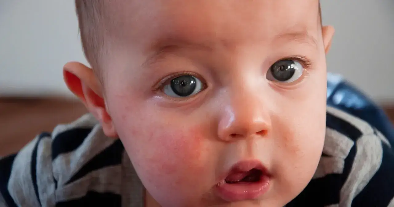 Skaza białkowa u niemowlaka objawia się zaczerwienieniem i suchością sk&oacute;ry na policzkach.