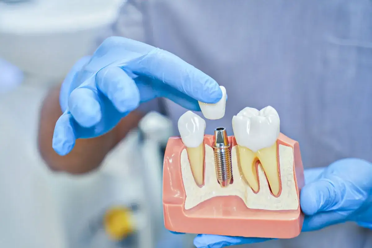 Model szczęki z implantem i koroną. Dentysta wyjaśnia, ile kosztuje wprawienie zęba.