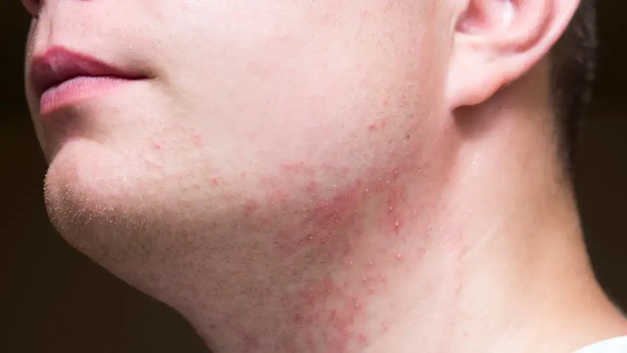 skóra podrażniona po goleniu elektrycznym