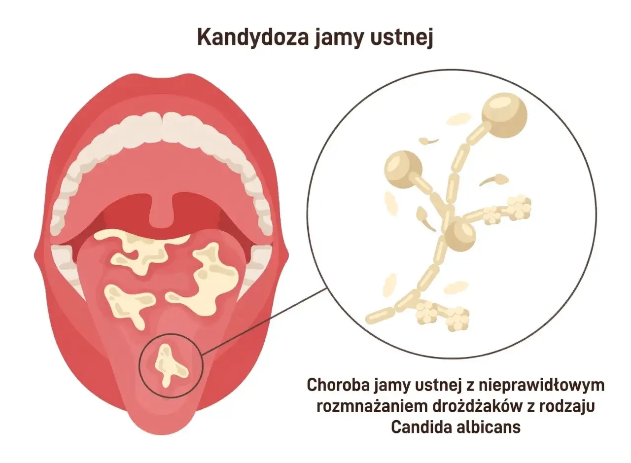 Ilustracja przedstawia jamę ustną z białymi nalotami, wskazującymi na kandydozę. Powiększony fragment ukazuje drożdżaki Candida albicans, które są przyczyną tej choroby.