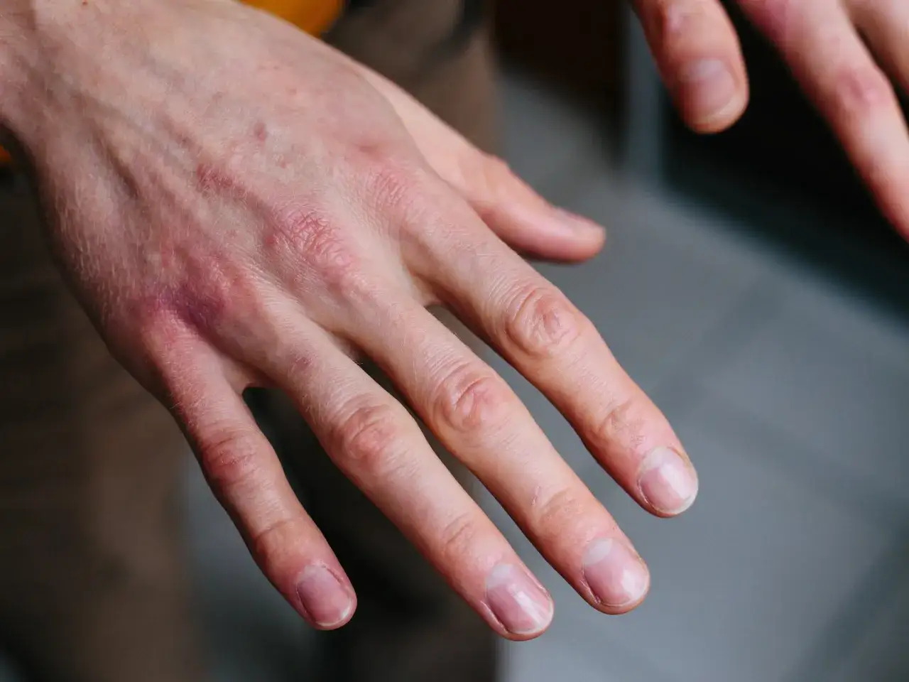Pękająca sk&oacute;ra dłoni z widocznymi ranami i zaczerwienieniem. Dłonie wymagają nawilżenia i pielęgnacji.