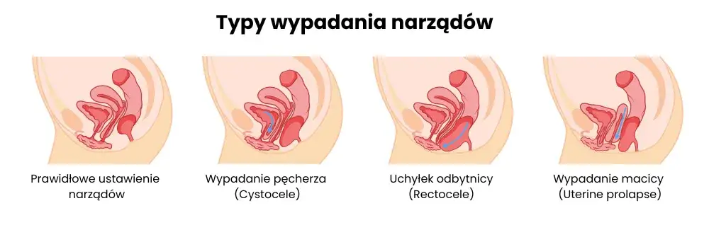 problemy uroginekologiczne, dysfunkcje dna miednicy