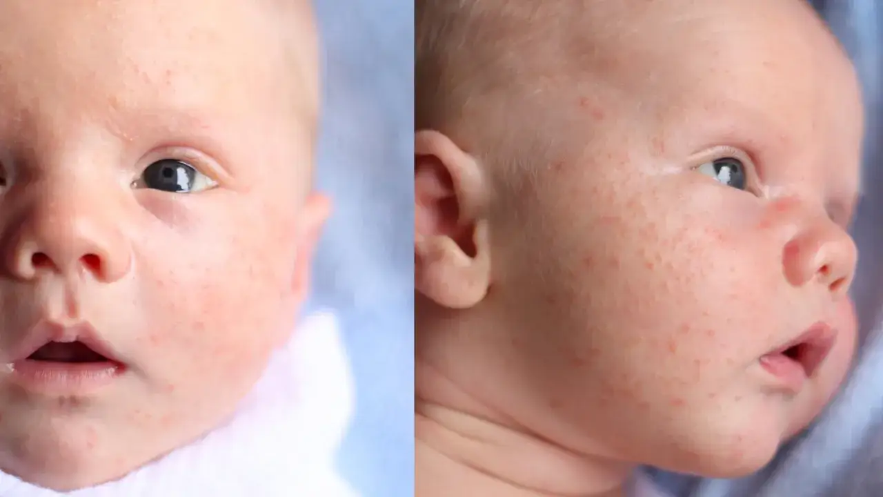 Różnice między trądzikiem niemowlęcym a wysypką alergiczną