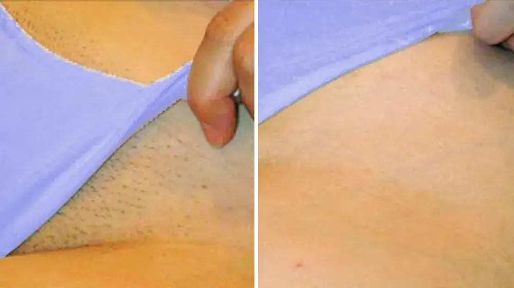 Depilacja laserowa bikini przed i po