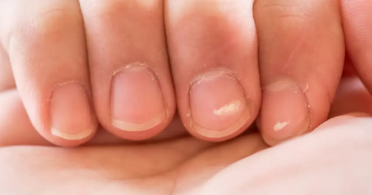 Zbliżenie na palce dłoni z widocznymi białymi plamkami na paznokciach, które mogą świadczyć o niedoborach.