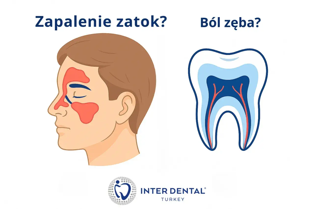 Zapalenie zatok czy b&oacute;l zęba? Ilustracja pokazuje zatoki i przekr&oacute;j zęba, sugerując, że b&oacute;l podniebienia przy zębach g&oacute;rnych może być związany z jednym z nich.