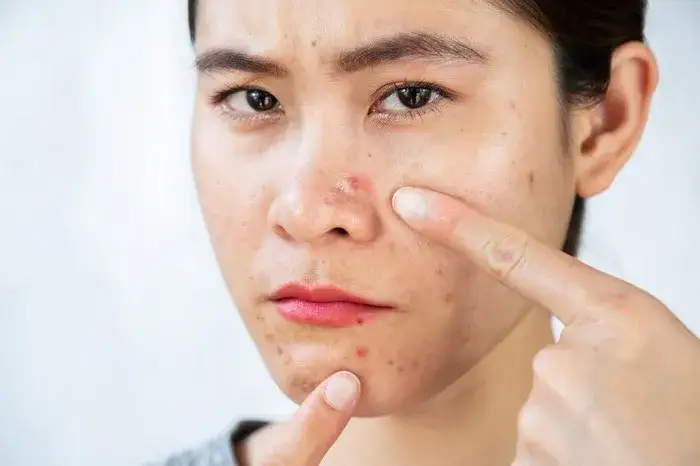 Zdjęcie Pryszcze na nosie od czego – poznaj przyczyny i skuteczne rozwiązania