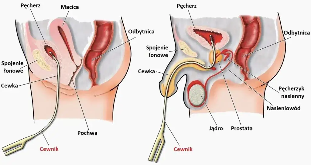 Objawy infekcji dr&oacute;g moczowych po cewnikowaniu