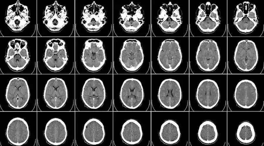 mózg ADHD rezonans obszary