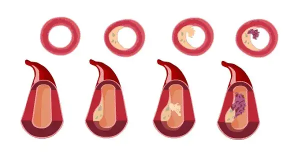 proces tworzenia blaszki miażdżycowej