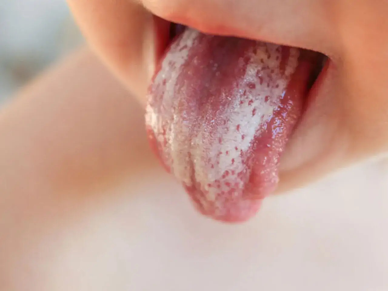 Czerwony język z białym nalotem, wystający z ust.