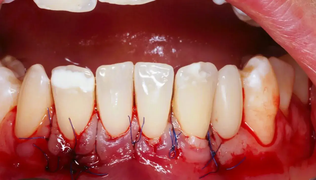 Po zabiegu stomatologicznym widoczne są odsłonięte szyjki zębowe, zęby z wypełnieniem i zszyte dziąsła.