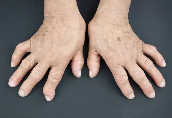 objawy b&oacute;lu kości staw&oacute;w swędzenia sk&oacute;ry